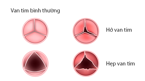 Van tim - Hình ảnh minh họa